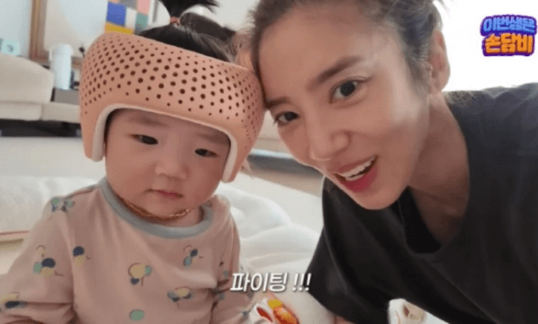 نشرت سون دام بي صوراً لابنتها البالغة من العمر 8 أشهر قبل وبعد 5 أسابيع من عملية تصحيح شكل الرأس